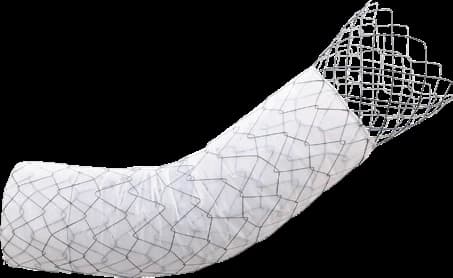 Taewoong Niti-S COMVI enteral colonic stent with uncovered proximal flare end, curved body
