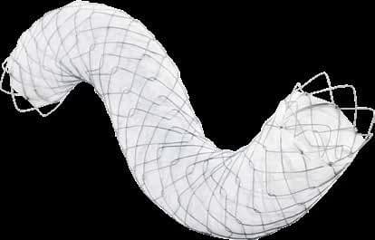Taewoong Niti-S COMVI covered biliary stent with braided flared ends, flexed in an S-curve