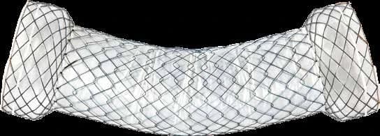 Taewoong Niti-S DUAL esophageal stent with wide double-layered flared ends