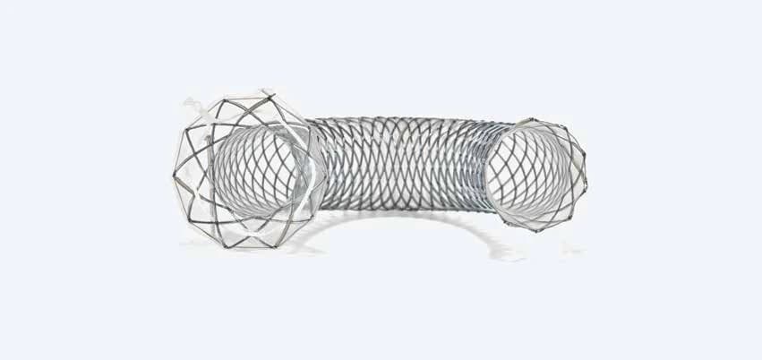 Taewoong Niti-S flare biliary stent with wide flared ends